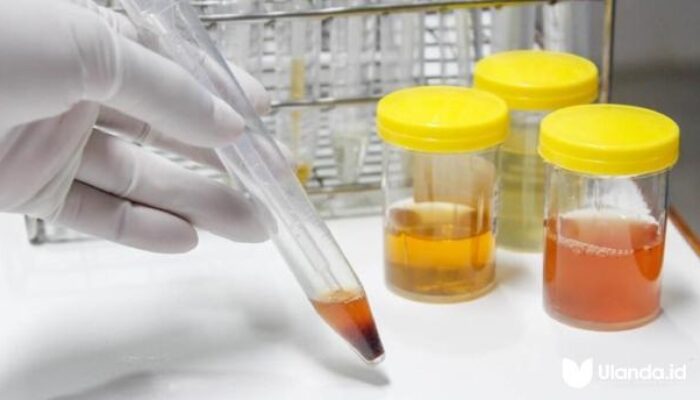 Waspada! Ini Warna Urine yang Mengindikasikan Gangguan Ginjal