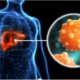 Ilustrasi Foto Hepatitis B