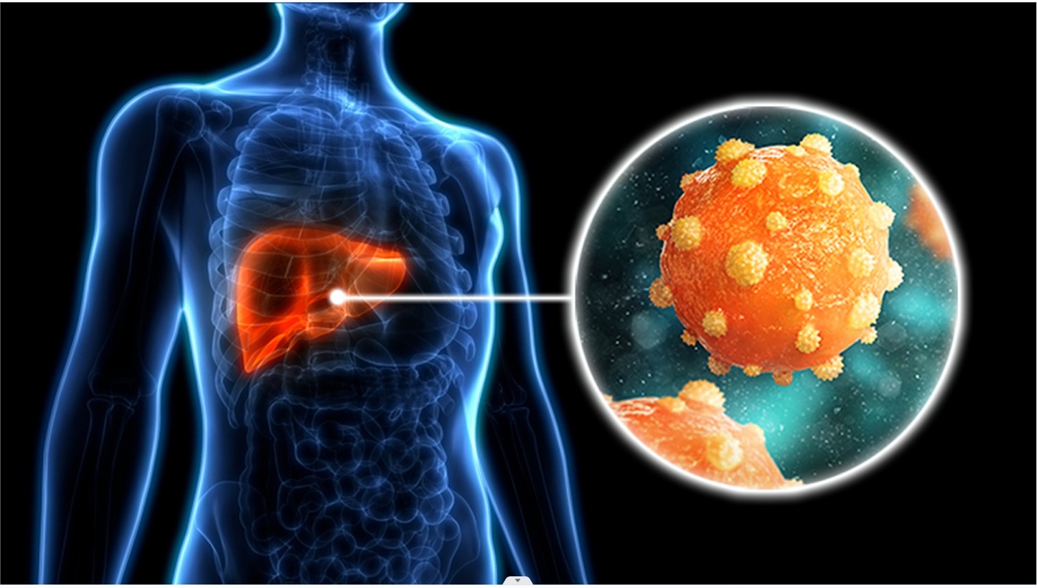 Ilustrasi Foto Hepatitis B