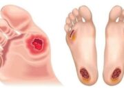 Ilustrasi luka komplikasi Diabetes yang sering dialami pada kaki pasien penderita. (Foto : Pinterest)/Ulanda.id