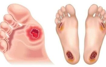 Ilustrasi luka komplikasi Diabetes yang sering dialami pada kaki pasien penderita. (Foto : Pinterest)/Ulanda.id