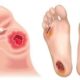 Ilustrasi luka komplikasi Diabetes yang sering dialami pada kaki pasien penderita. (Foto : Pinterest)/Ulanda.id