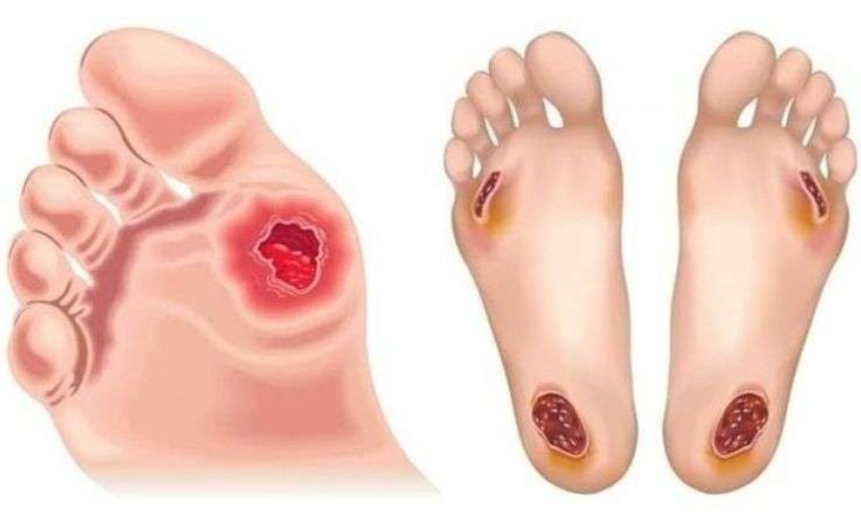 Ilustrasi luka komplikasi Diabetes yang sering dialami pada kaki pasien penderita. (Foto : Pinterest)/Ulanda.id