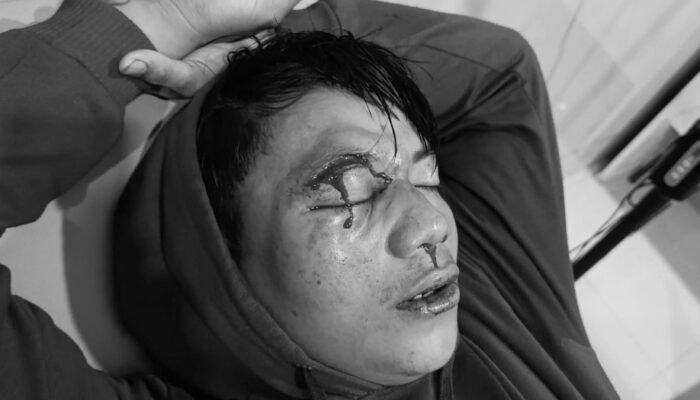 Mata Kiri Buta Akibat Penganiayaan, PMII Minta Kapolres Pohuwato Ambil Langkah Tegas