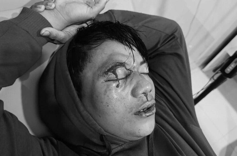 Kasus penganiayaan Reza di Pohuwato menuai sorotan. Korban kehilangan penglihatan/Ulanda.id